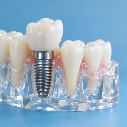 Temsili implant modeli